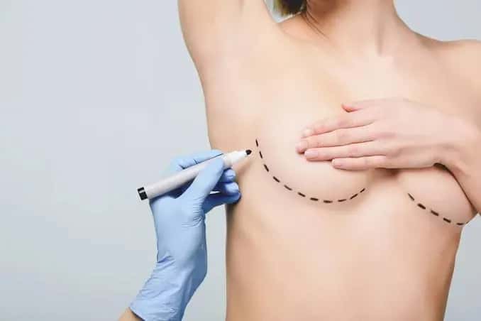 ¿Qué es la cirugía plástica de mama? Tipos, proceso y riesgos