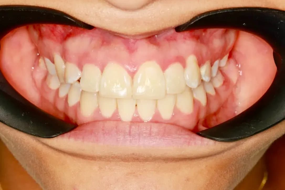 Ortodoncia - Después