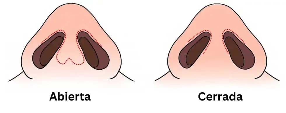 Open Rhinoplasty and Closed Rhinoplasty - The Real Differences