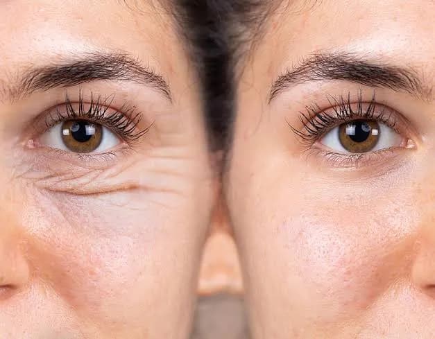 What Is Eyelid Surgery For? Types, Candidates & Benefits