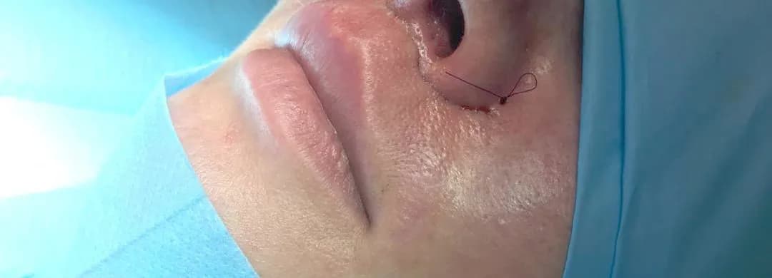Risks and Complications of Rhinoplasty: What You Need to Know