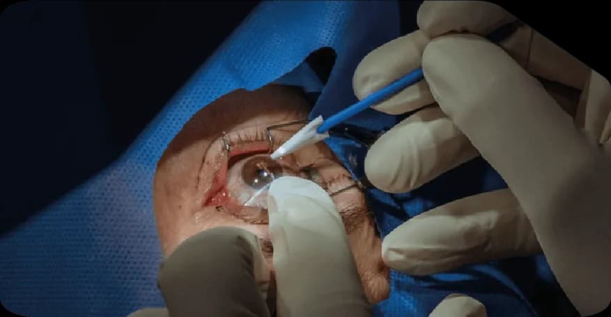 lasik