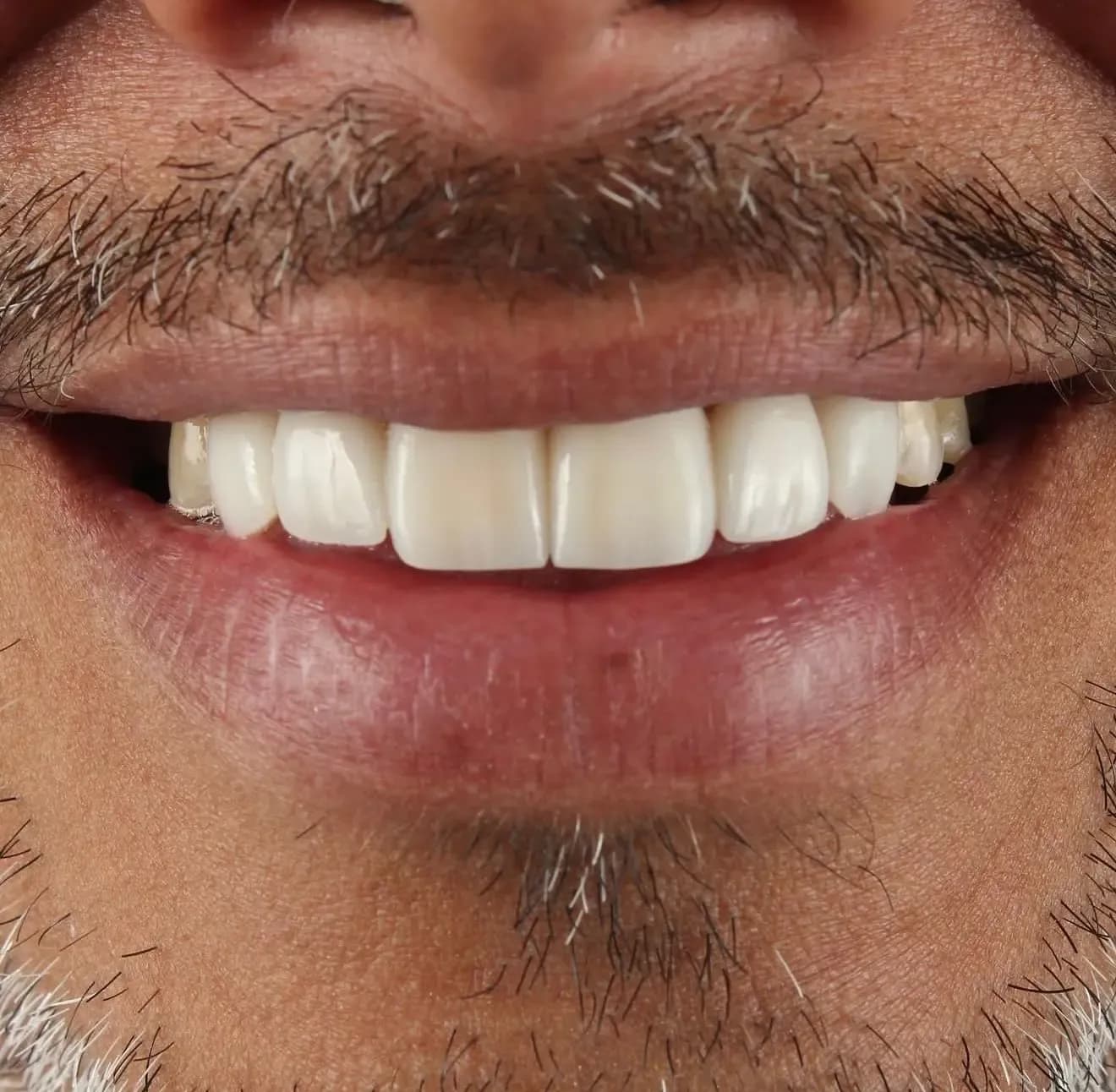 Carillas dentales en cerámica - Despues