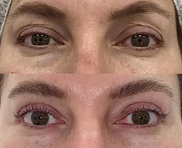 Bleflaroplastia