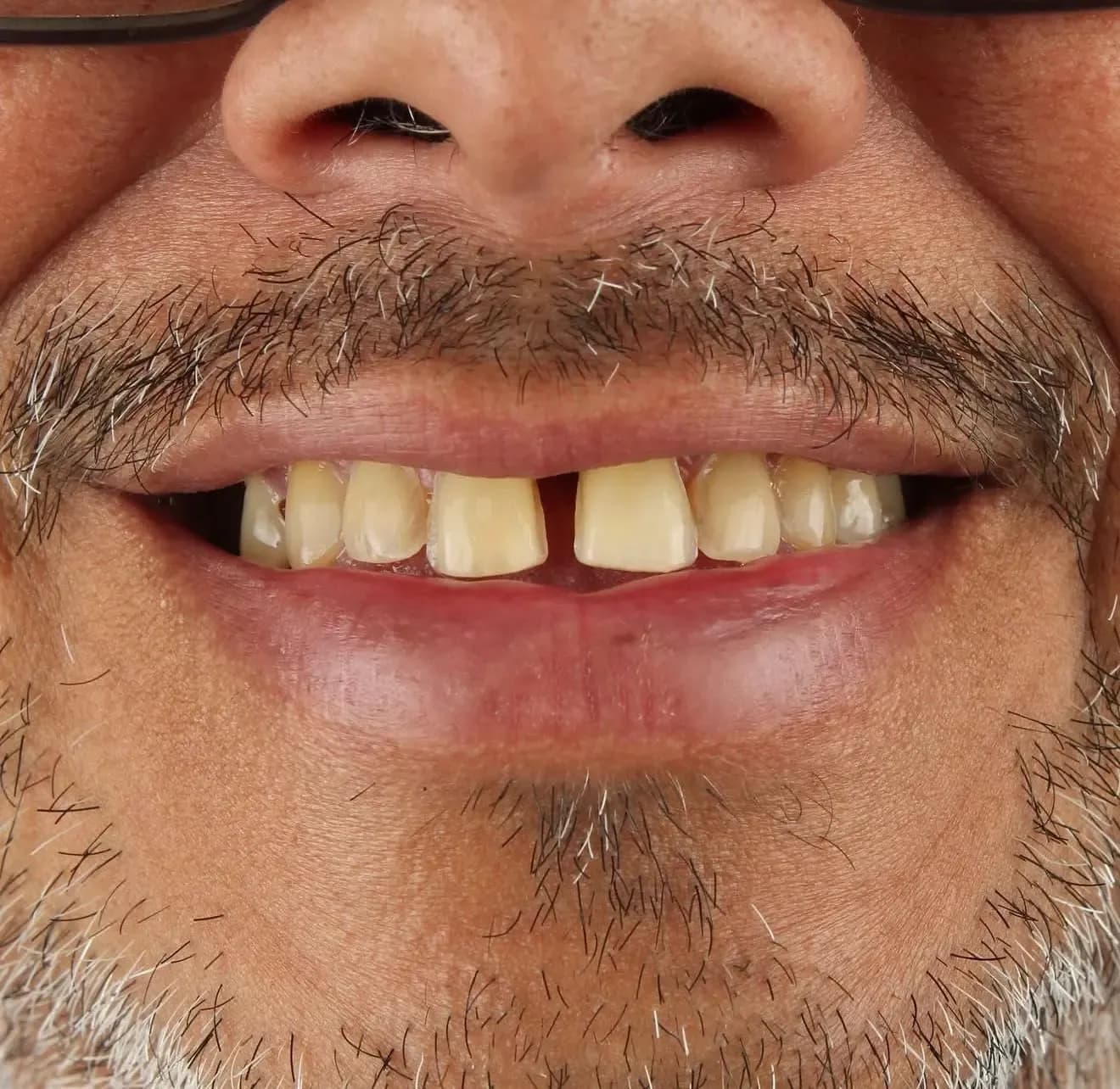 Carillas dentales en cerámica - Antes