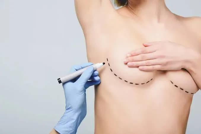 ¿Qué es la cirugía plástica de mama? Tipos, proceso y riesgos