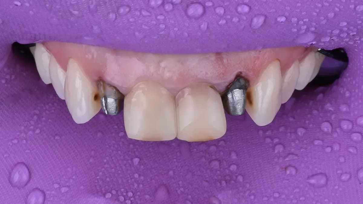 Implante dental - Antes