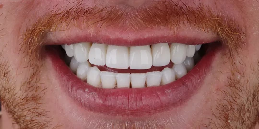 Diseño de Sonrisa - Después