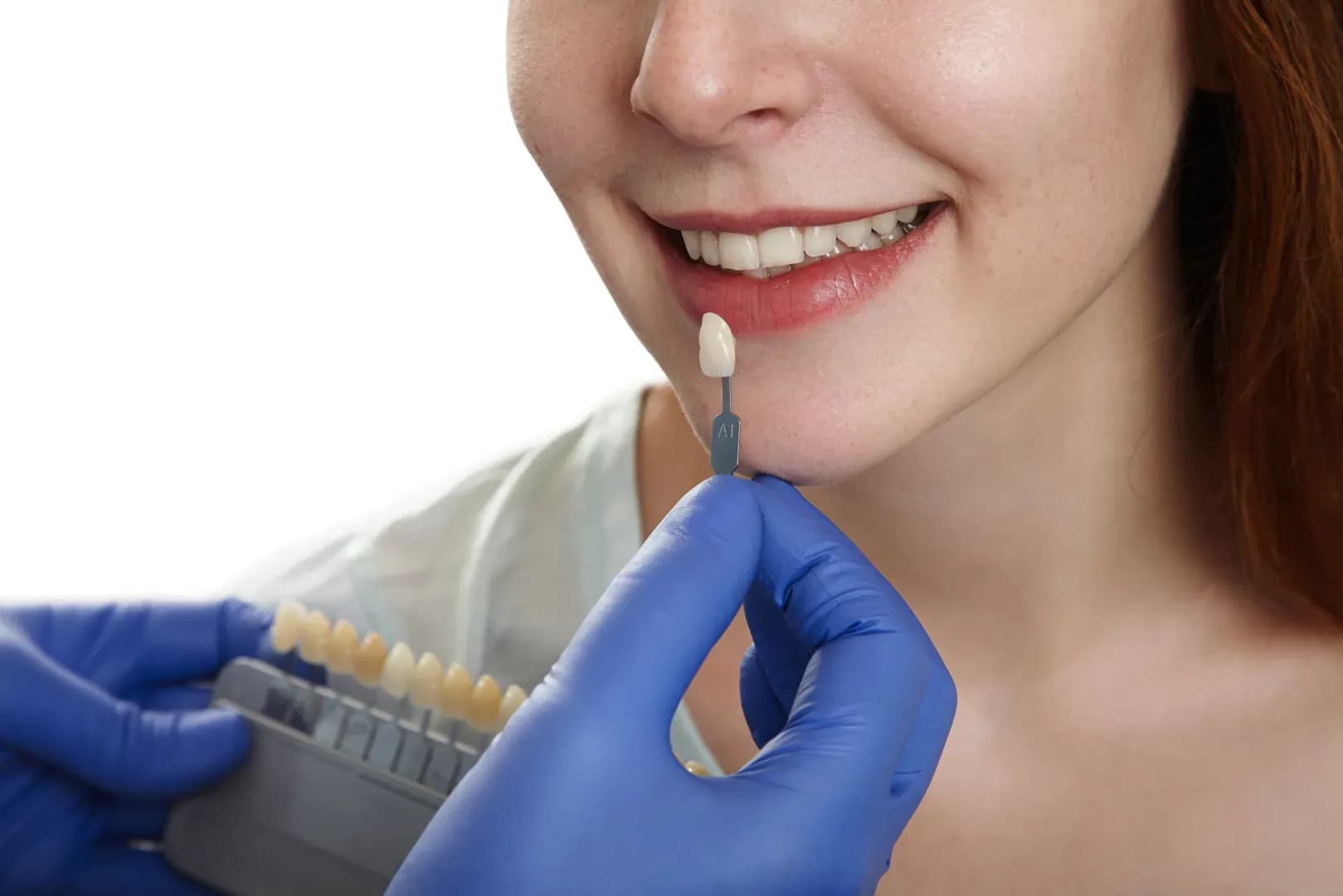  ¿Cuál es el precio de las carillas dentales en República Dominicana?