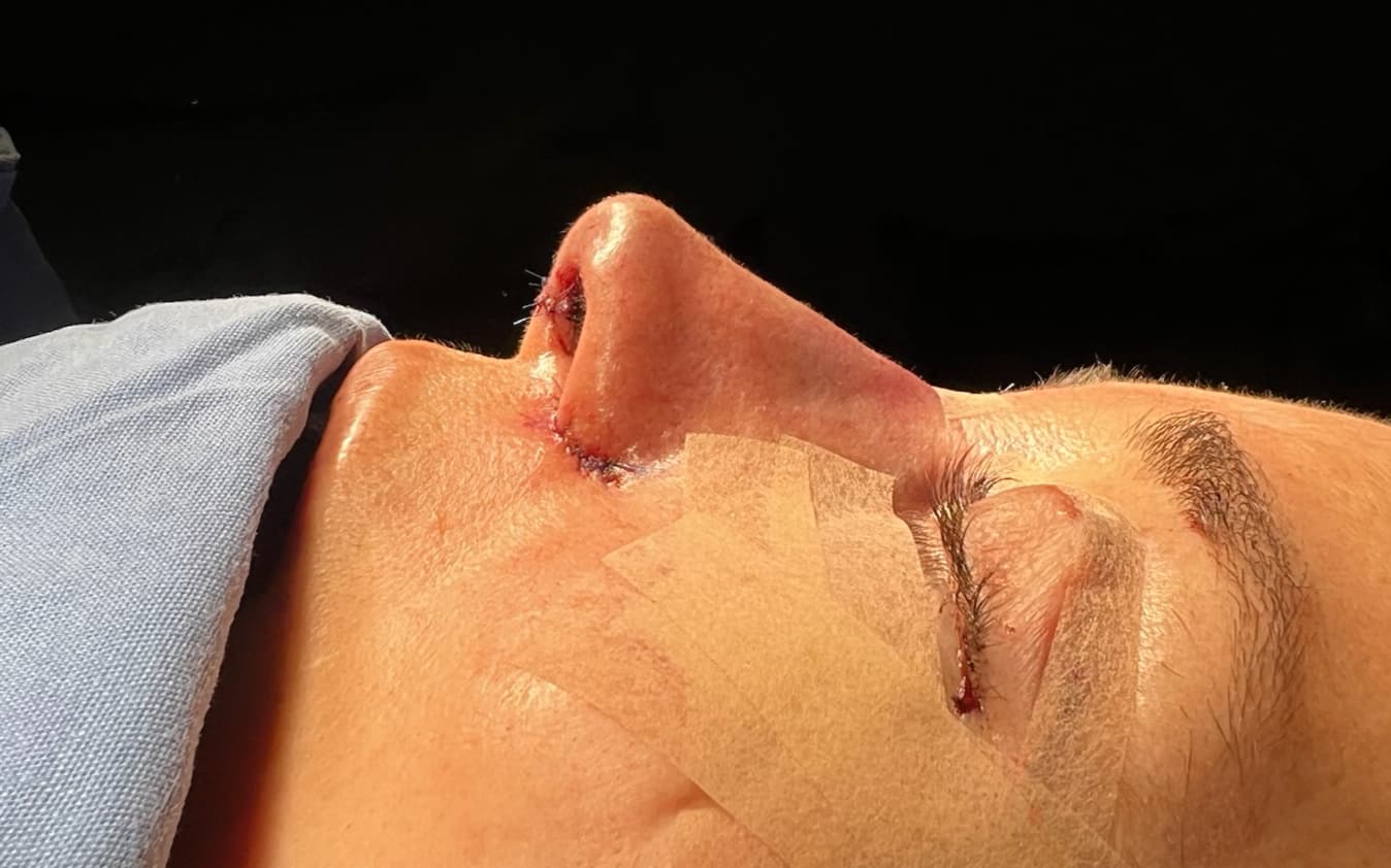 After Ultrasonic rhinoplasty