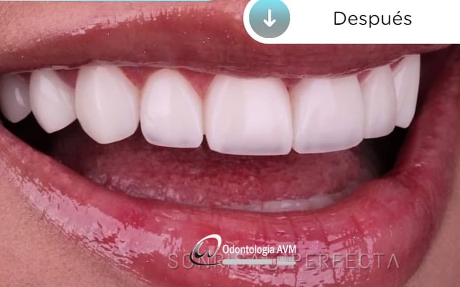 After Smile design