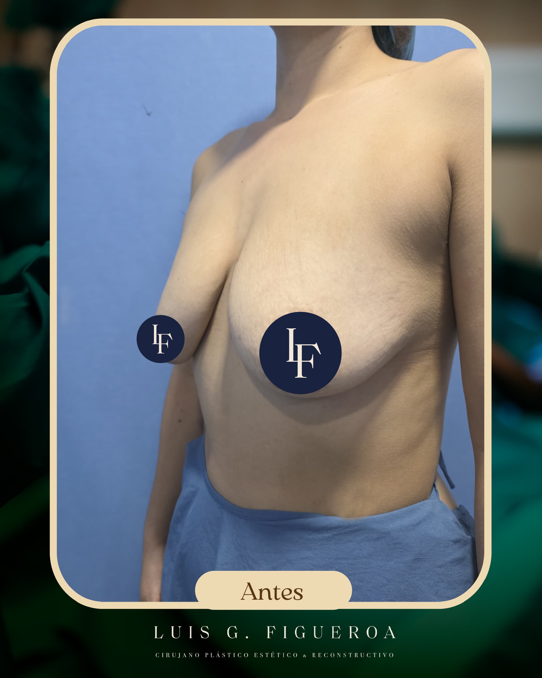 Before Maxtopexia con implantes