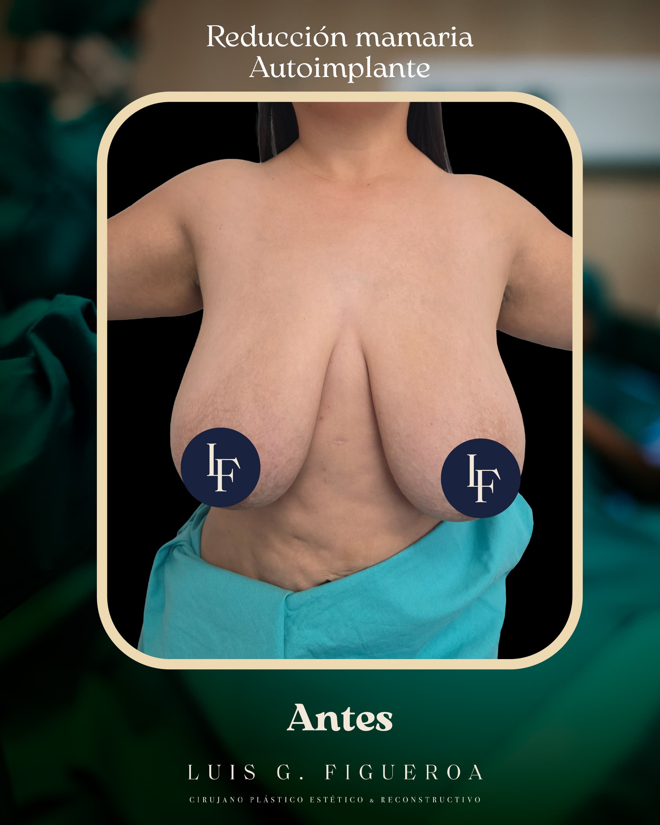 Before Reducción mamaria autoimplante
