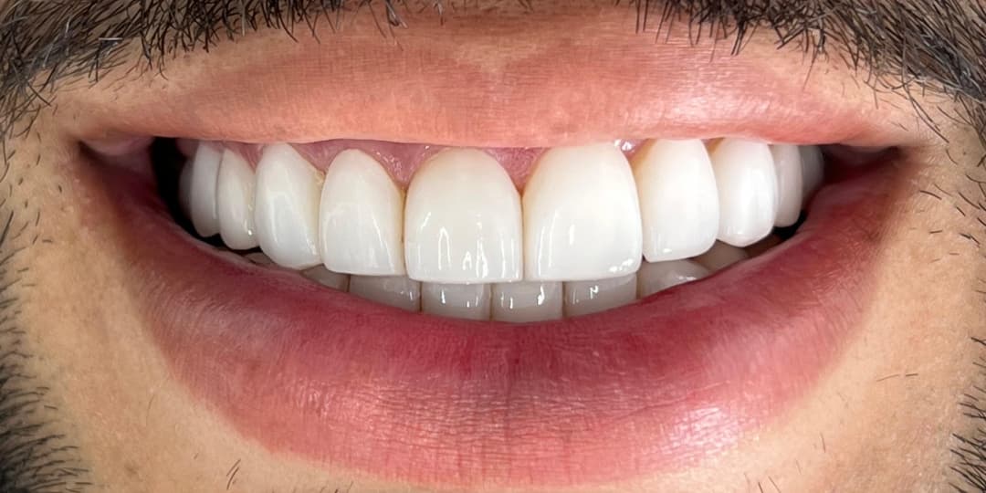 Before Carillas cerámicas