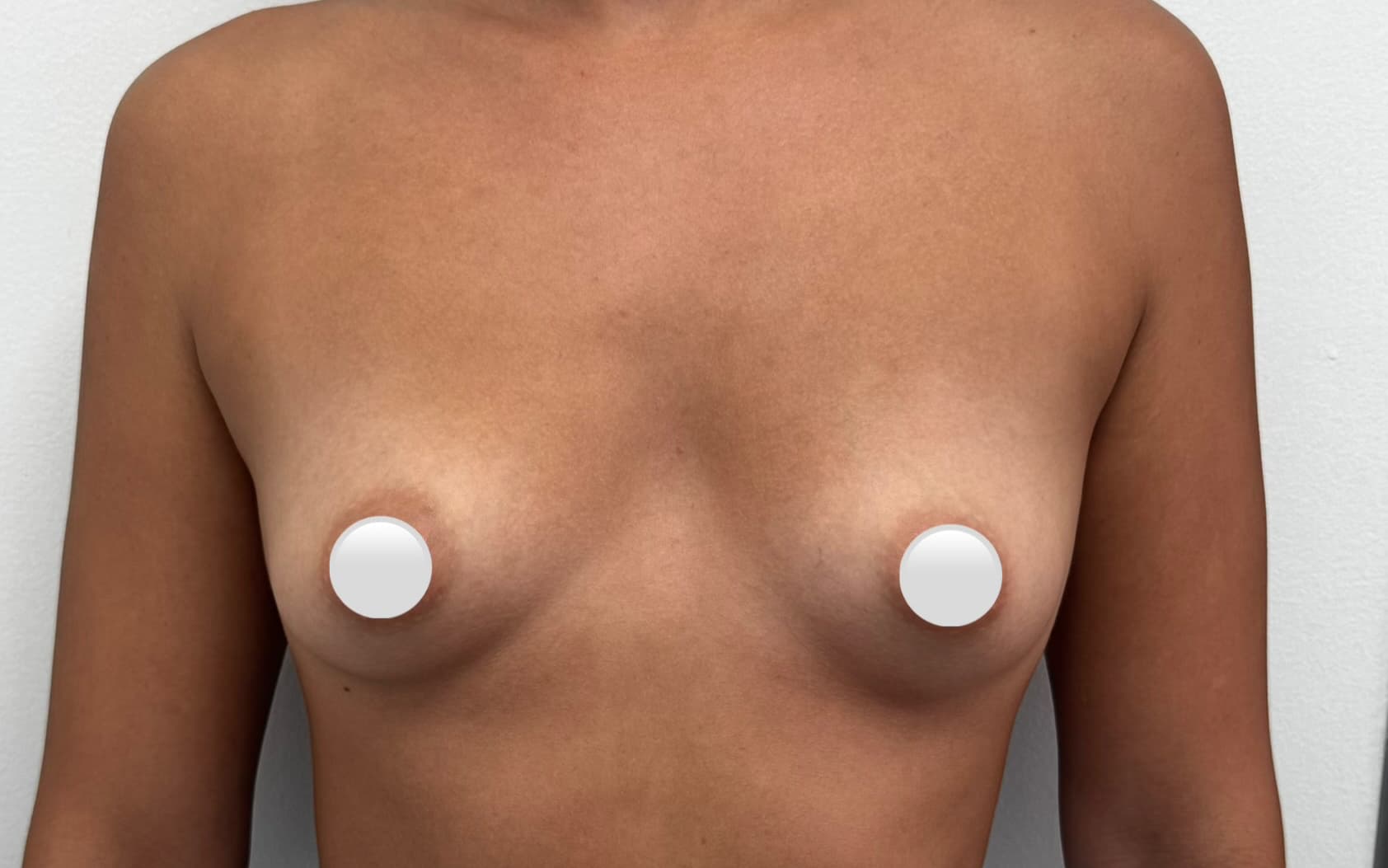 Before Augmentation mammaplasty