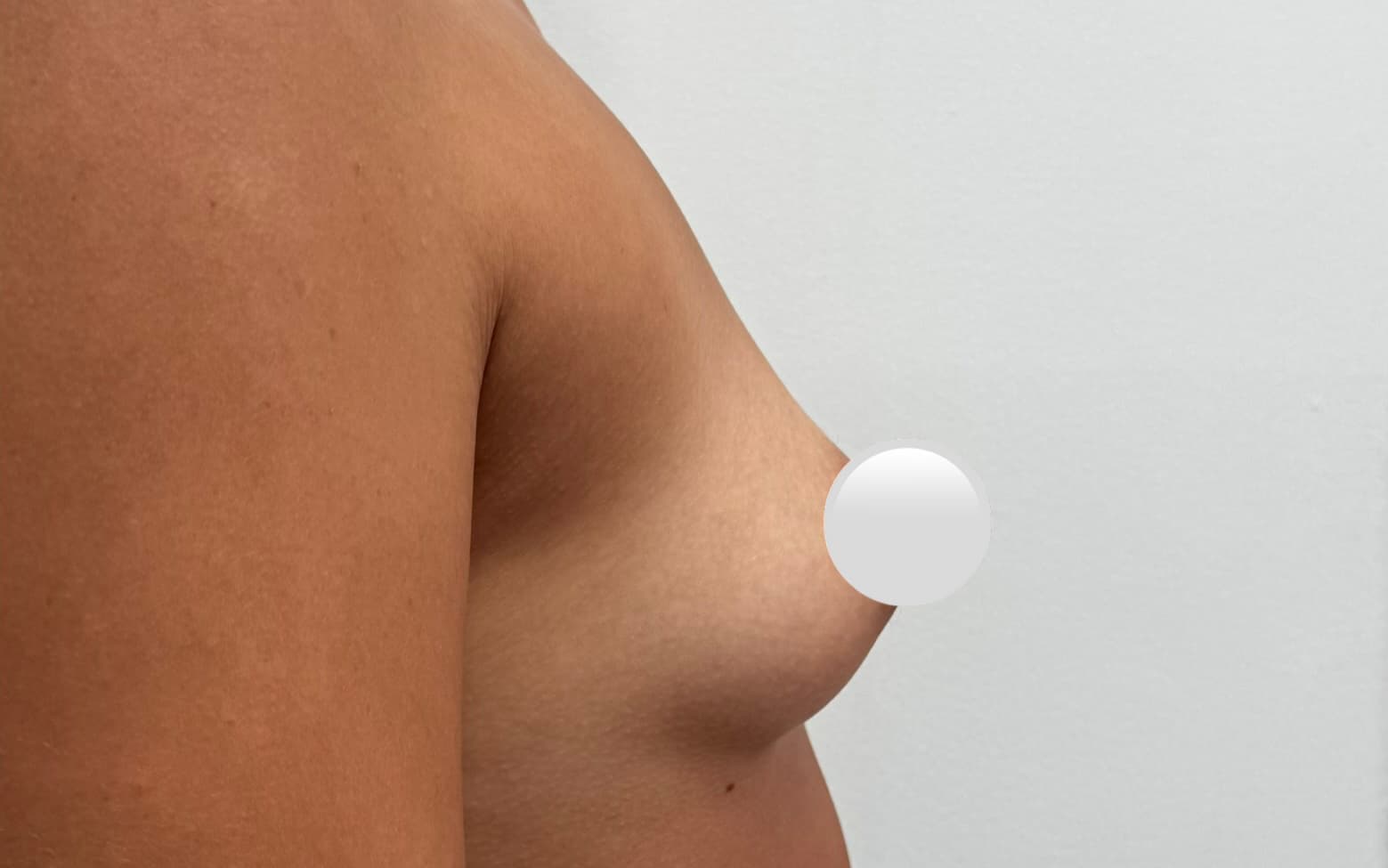 Before Augmentation mammaplasty
