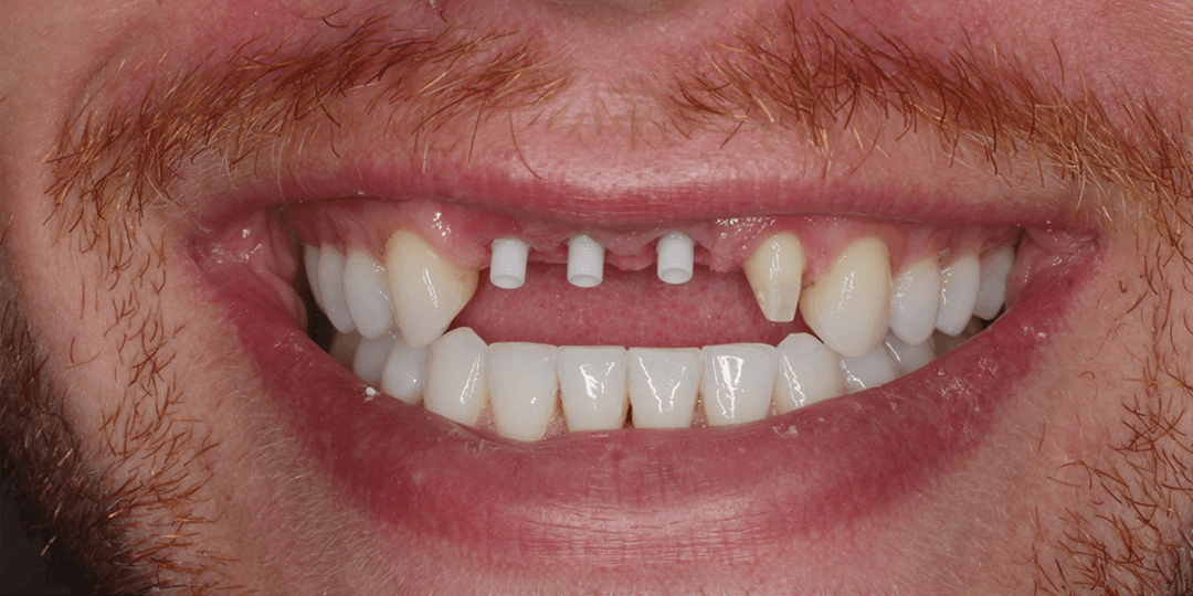 Before Implantes dentales - Diseño de Sonrisa en Cerámica