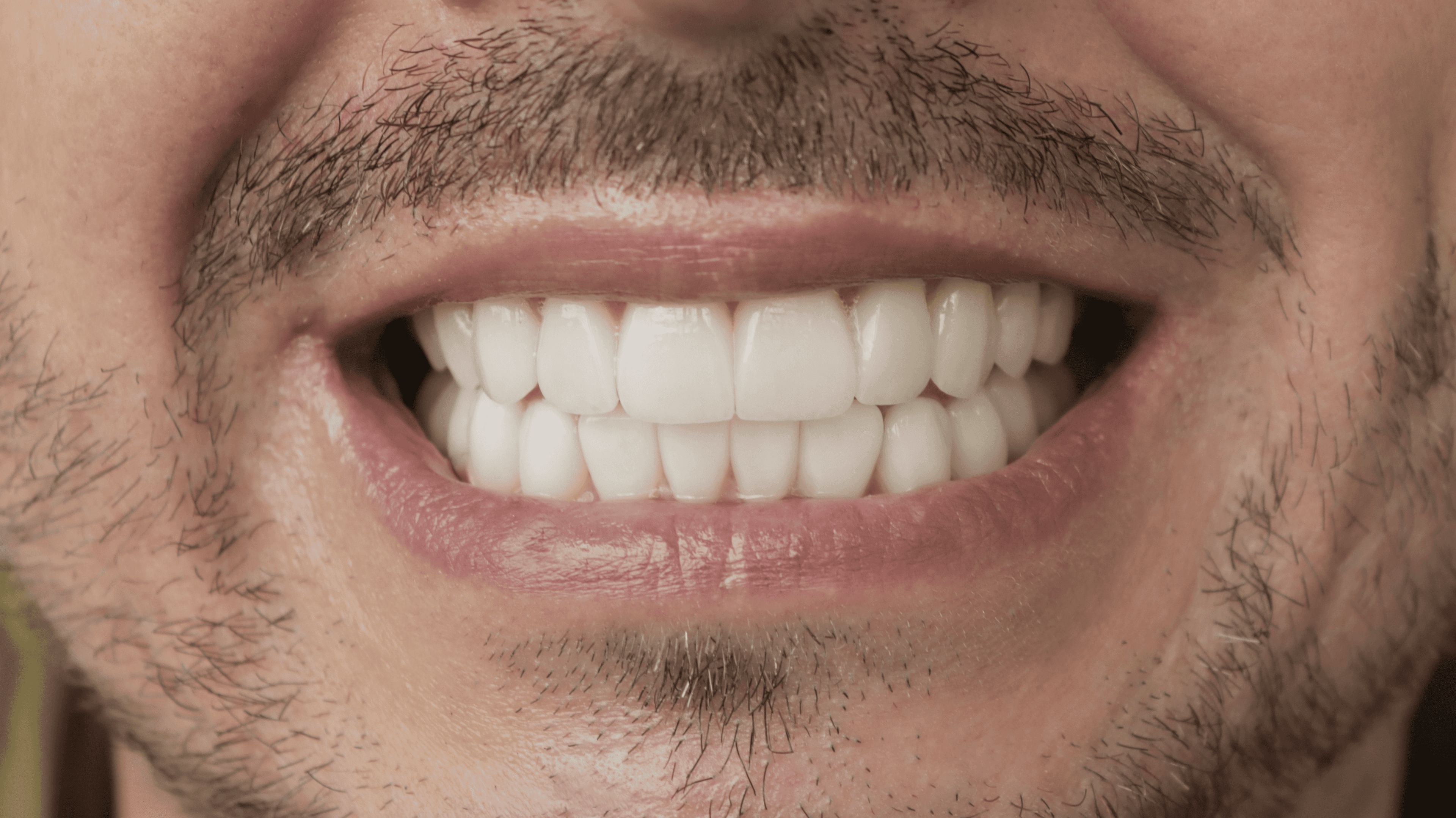 After Lentes Cerámicos 