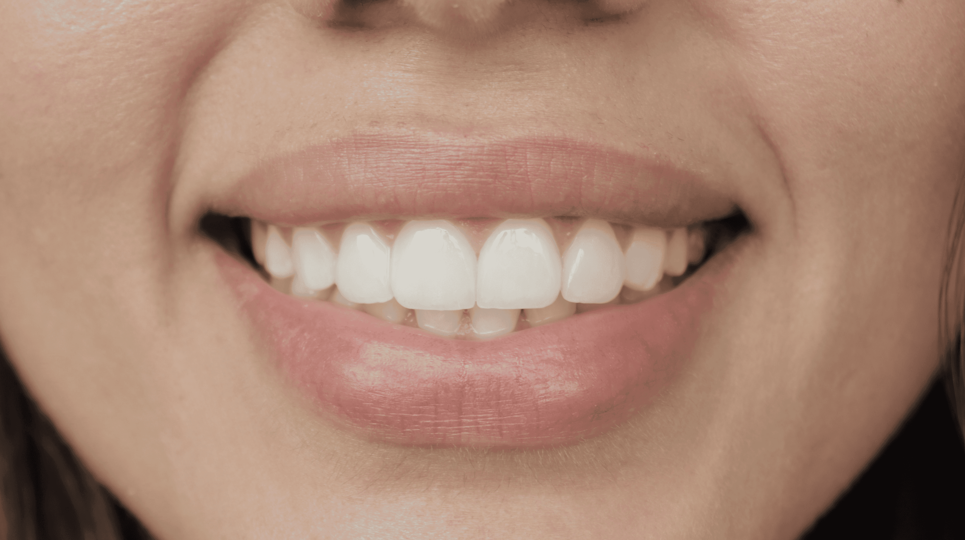 After Lentes Cerámicos Naturales