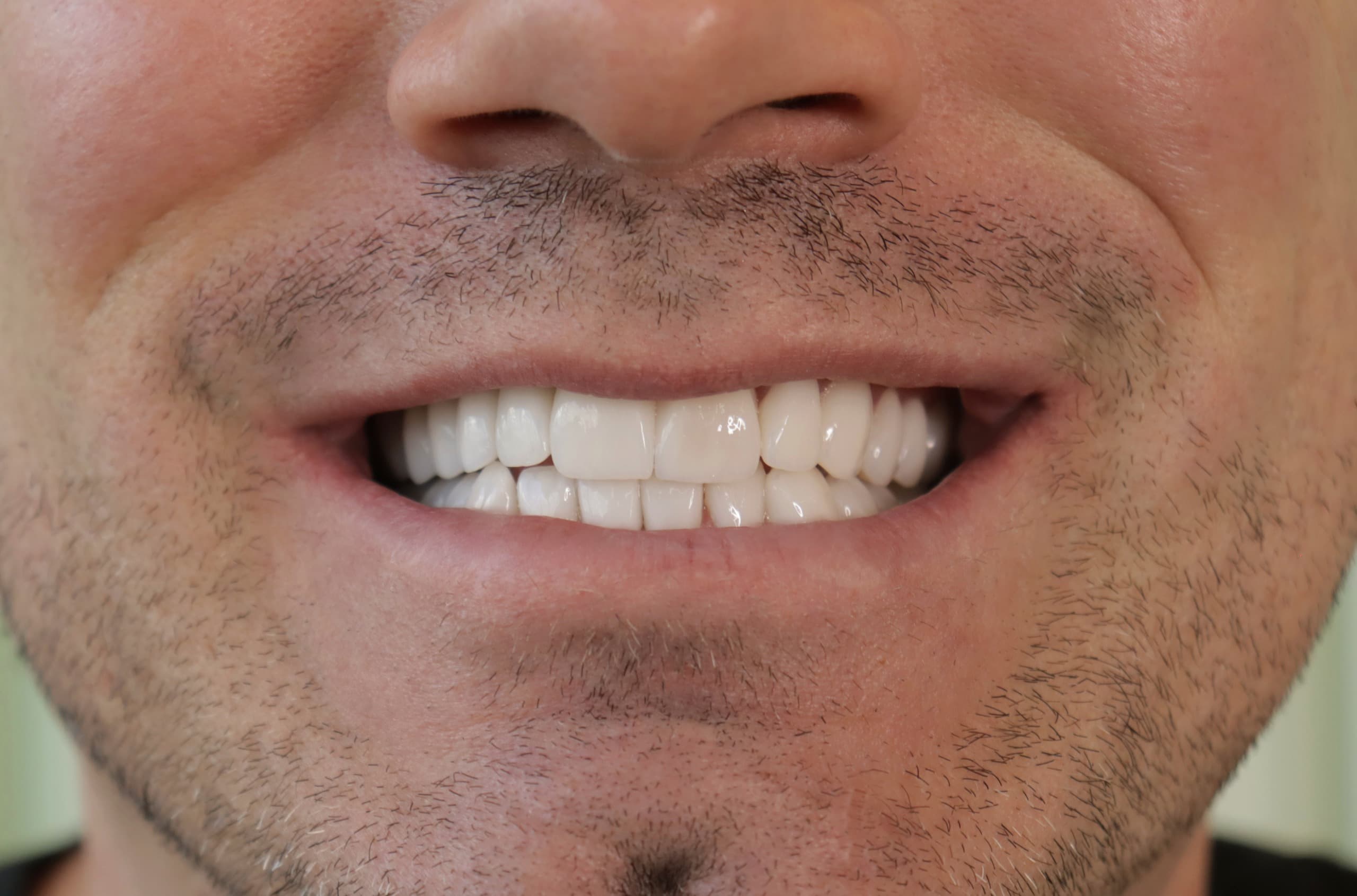 After Lentes Cerámicos Naturales 