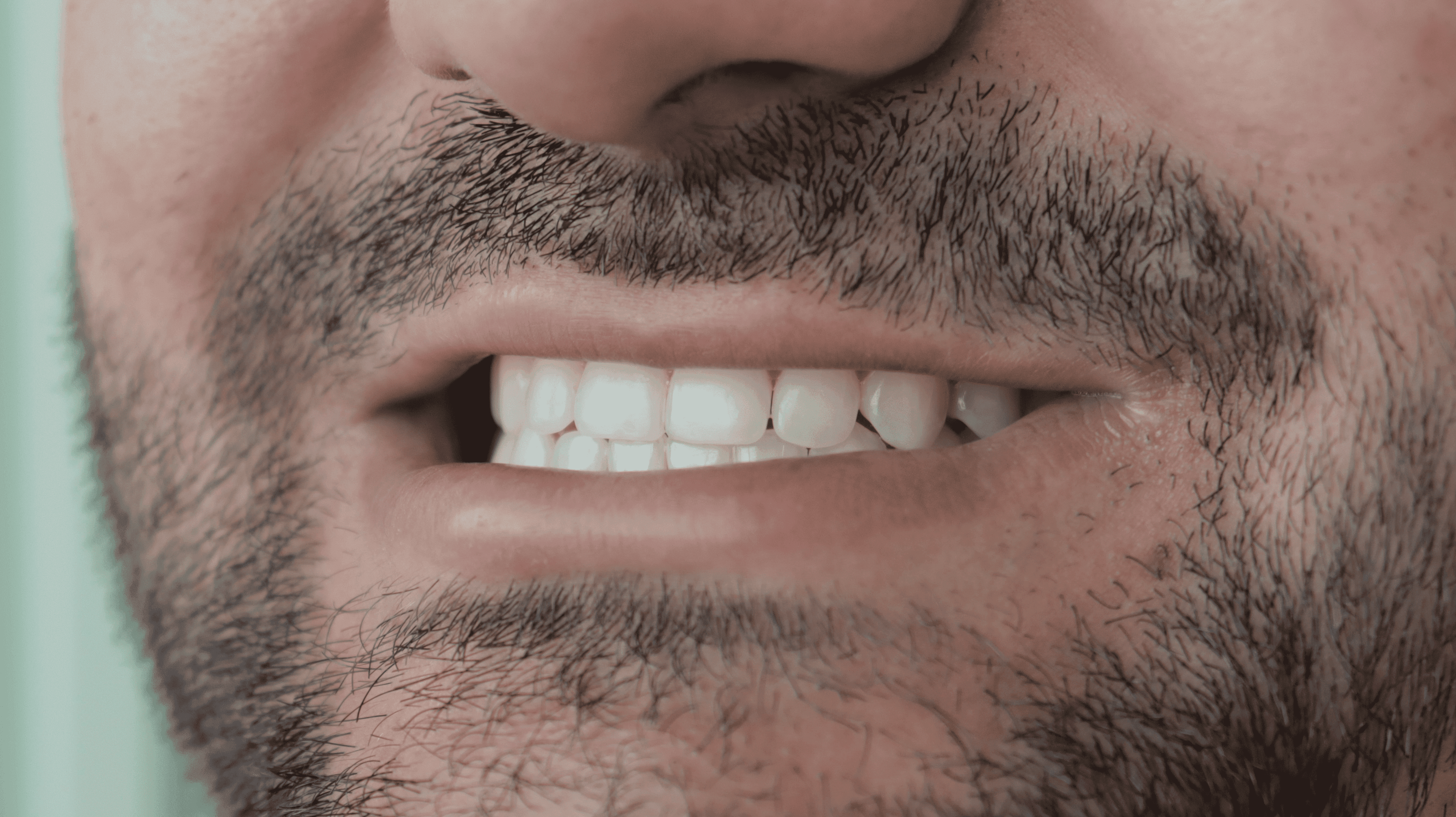 Before Lentes cerámicos naturales 