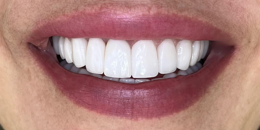 After Renovación de diseño de sonrisa