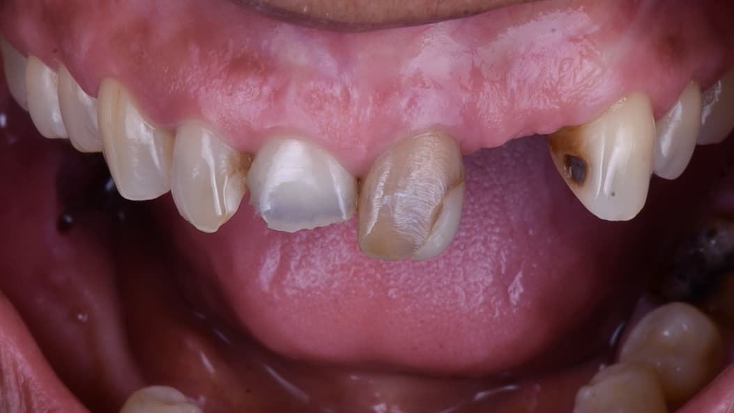 Before Coronas en circonio, con estratificación ceramica