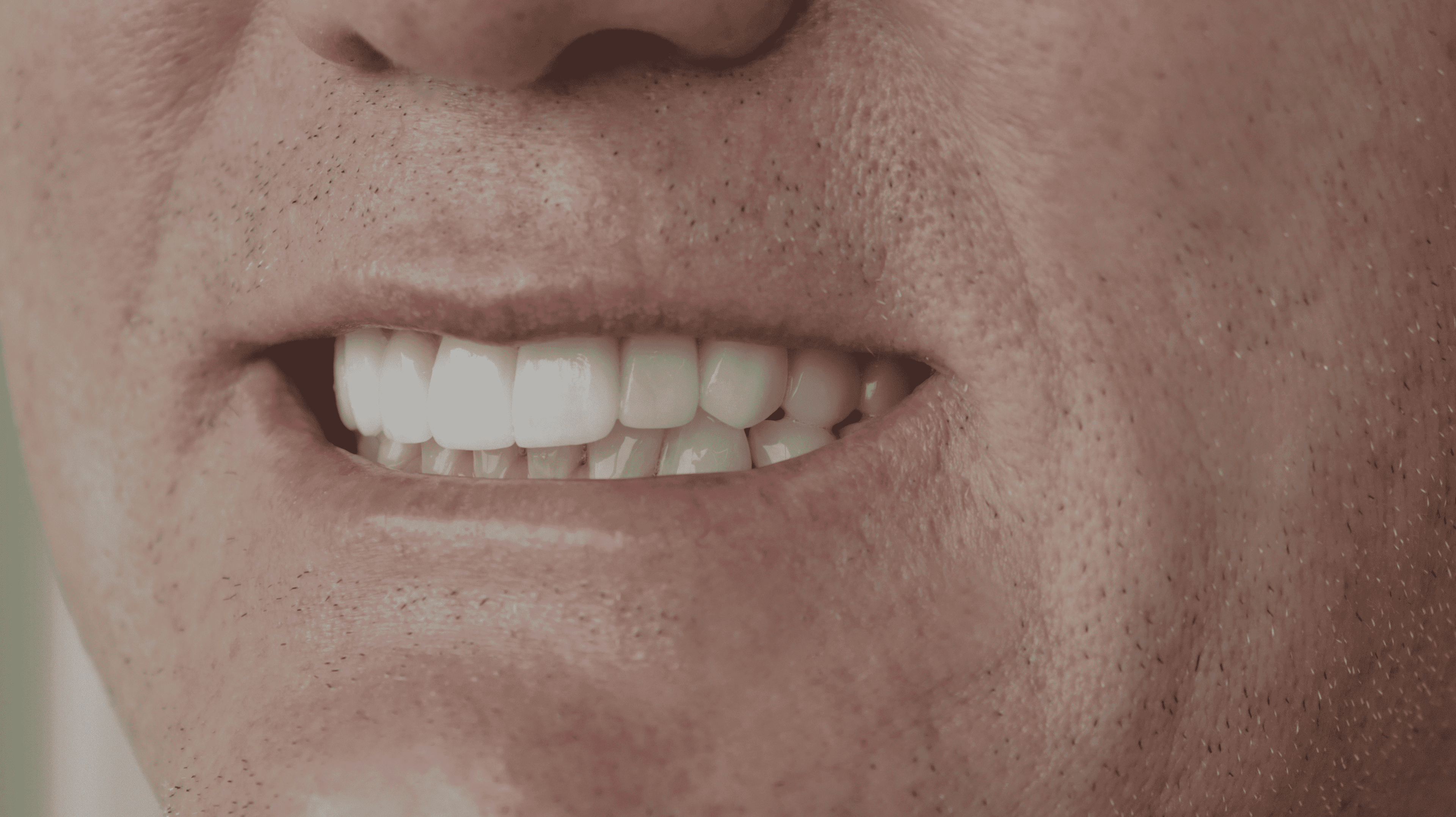 After Lentes cerámicos naturales 