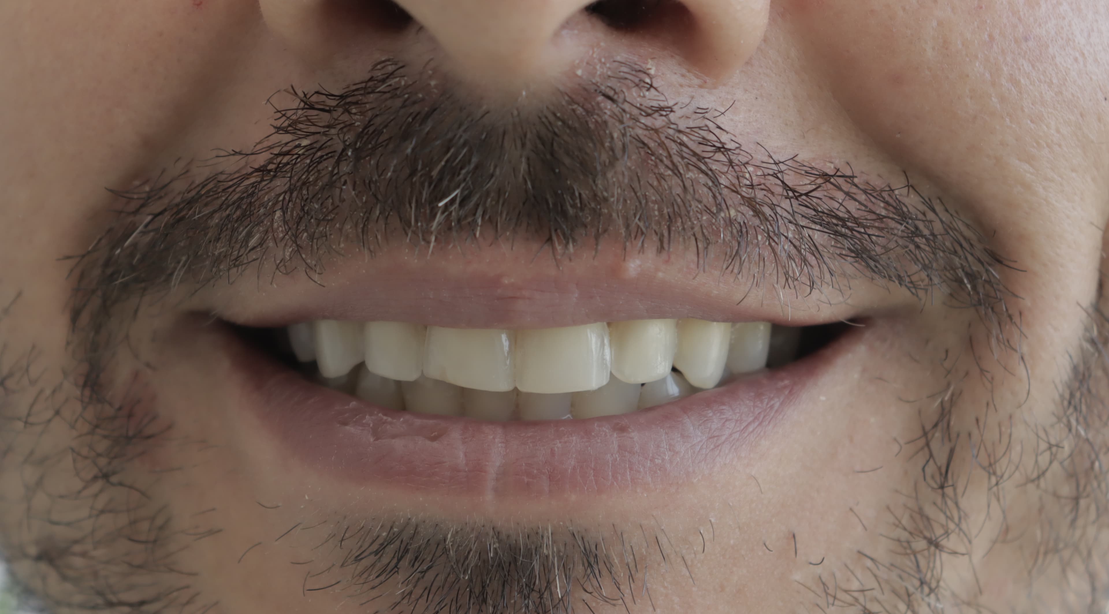 Before Lentes Cerámicos Naturales