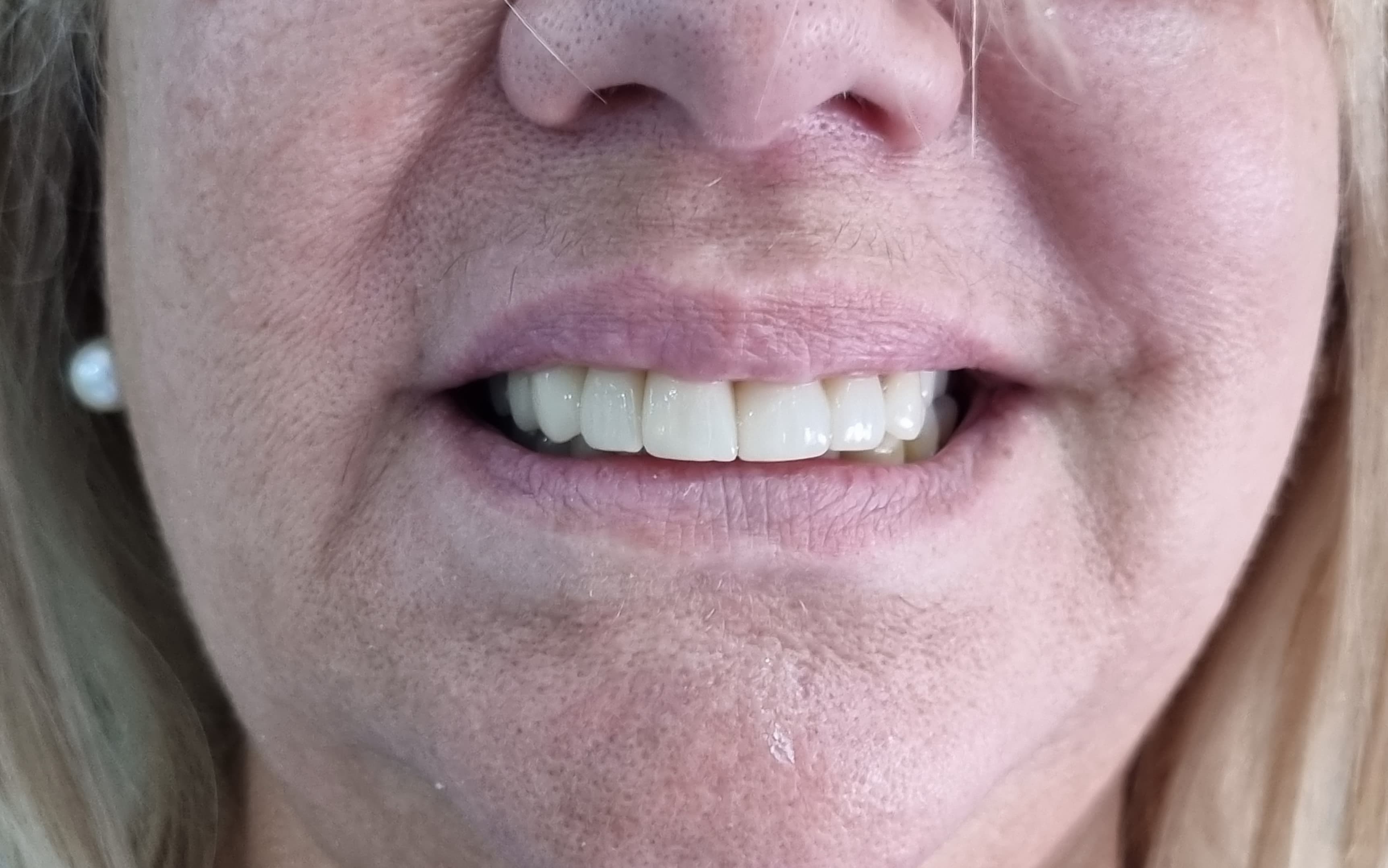 After Porcelain veneers