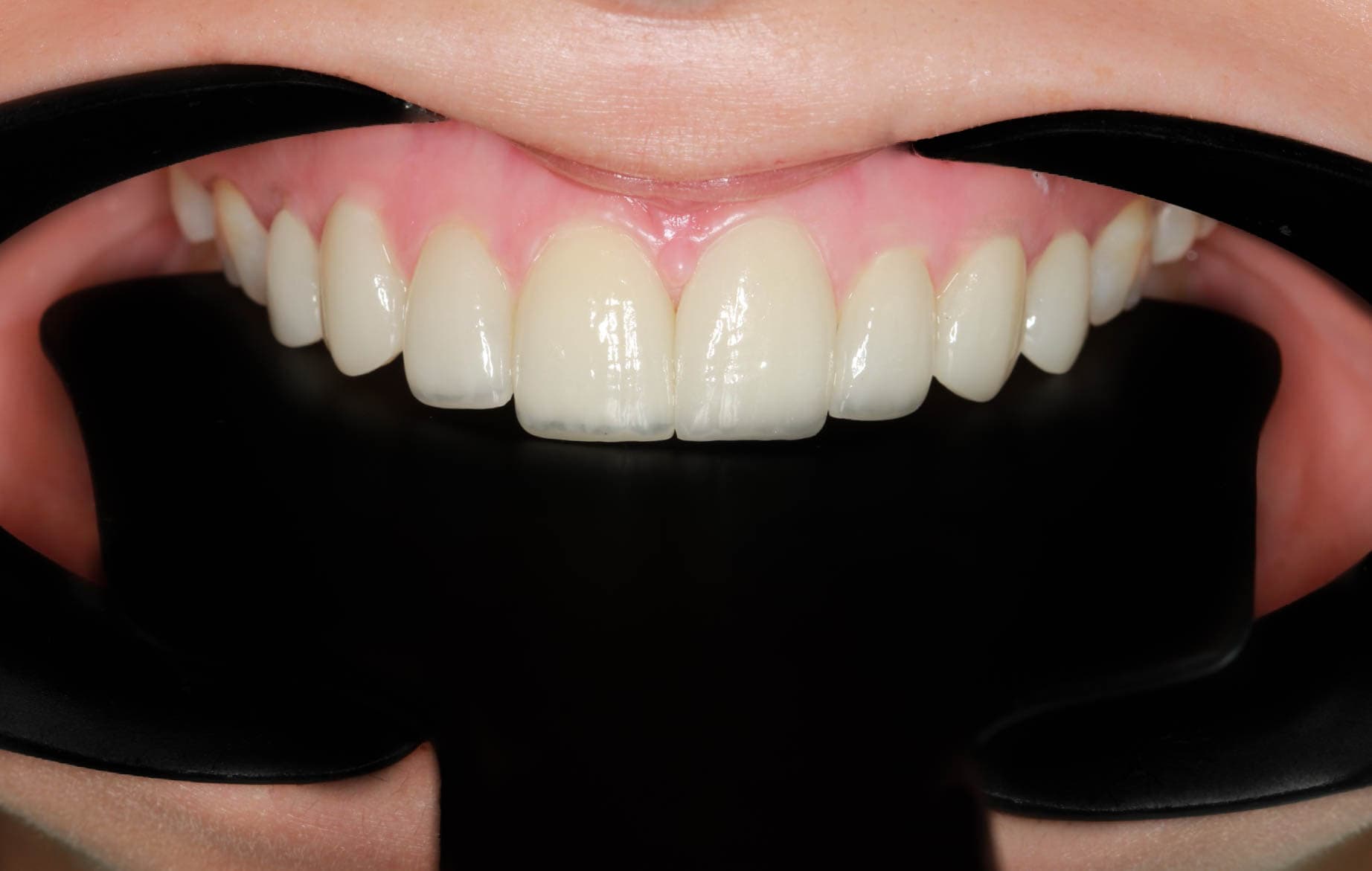 After Lentes Cerámicos Naturales