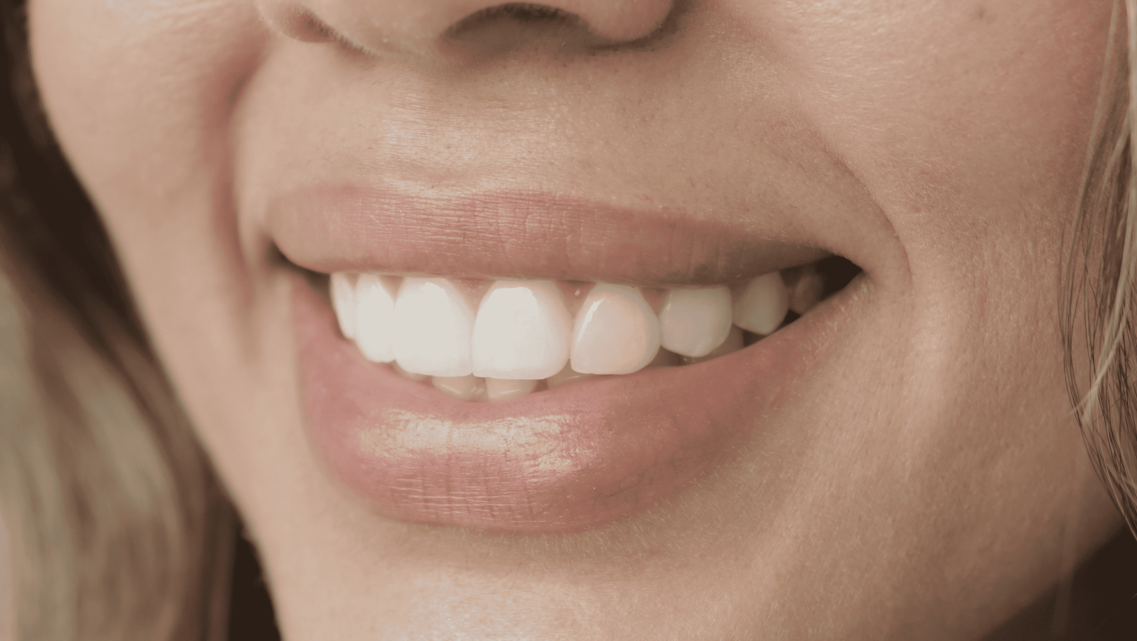 After Lentes Cerámicos Naturales 