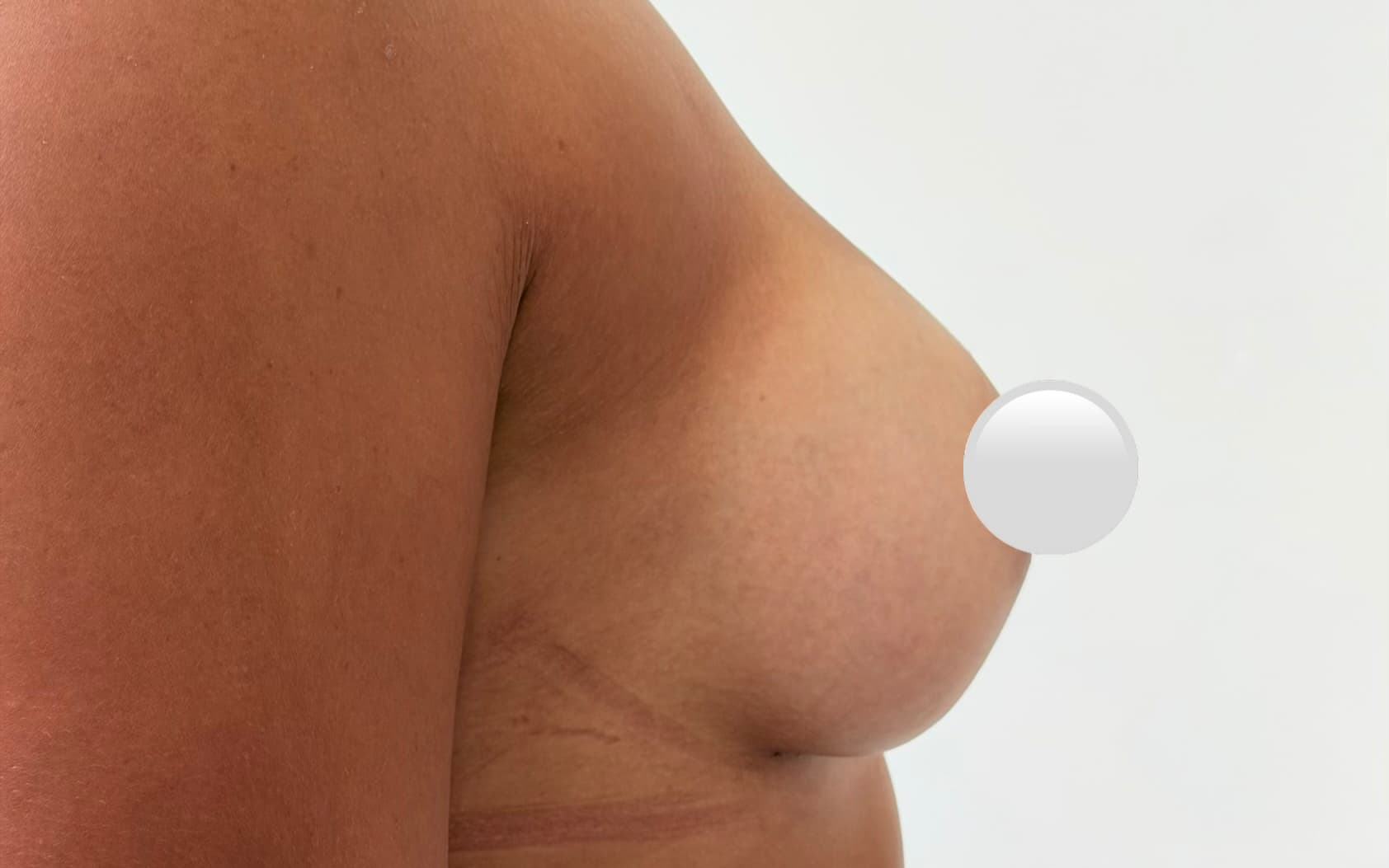 After Augmentation mammaplasty