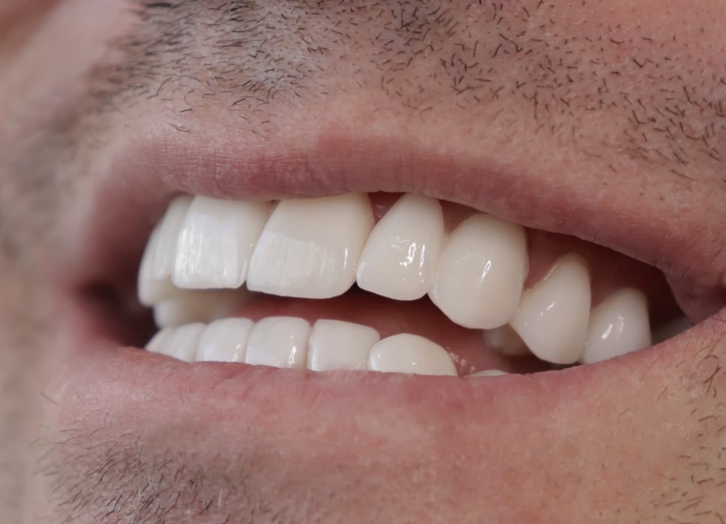 After Lentes Cerámicos Naturales