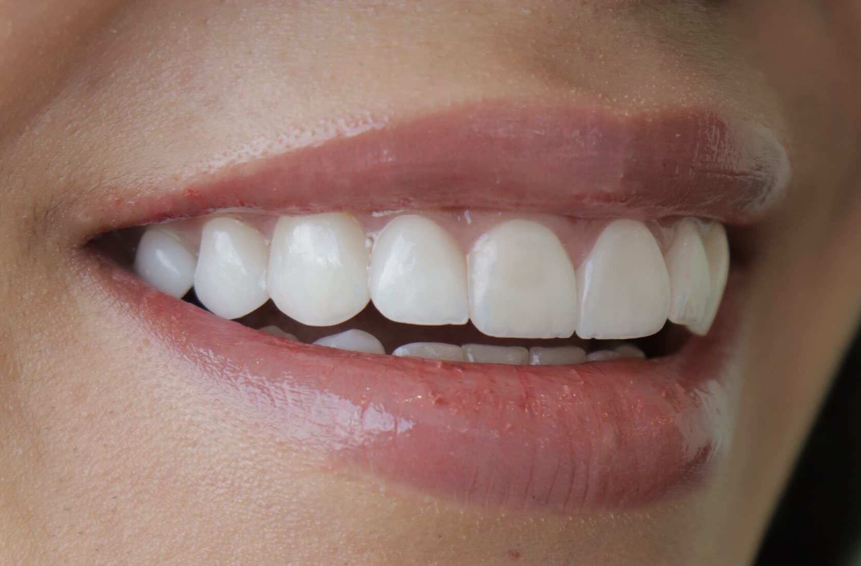 After Lentes cerámicos naturales 