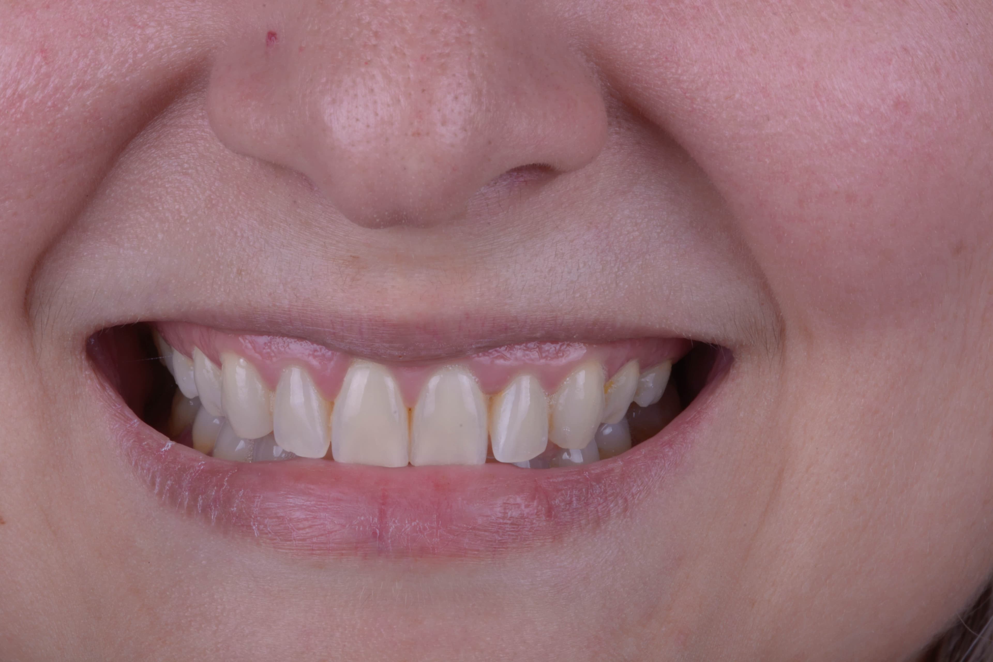 Before Blanqueamiento dental 