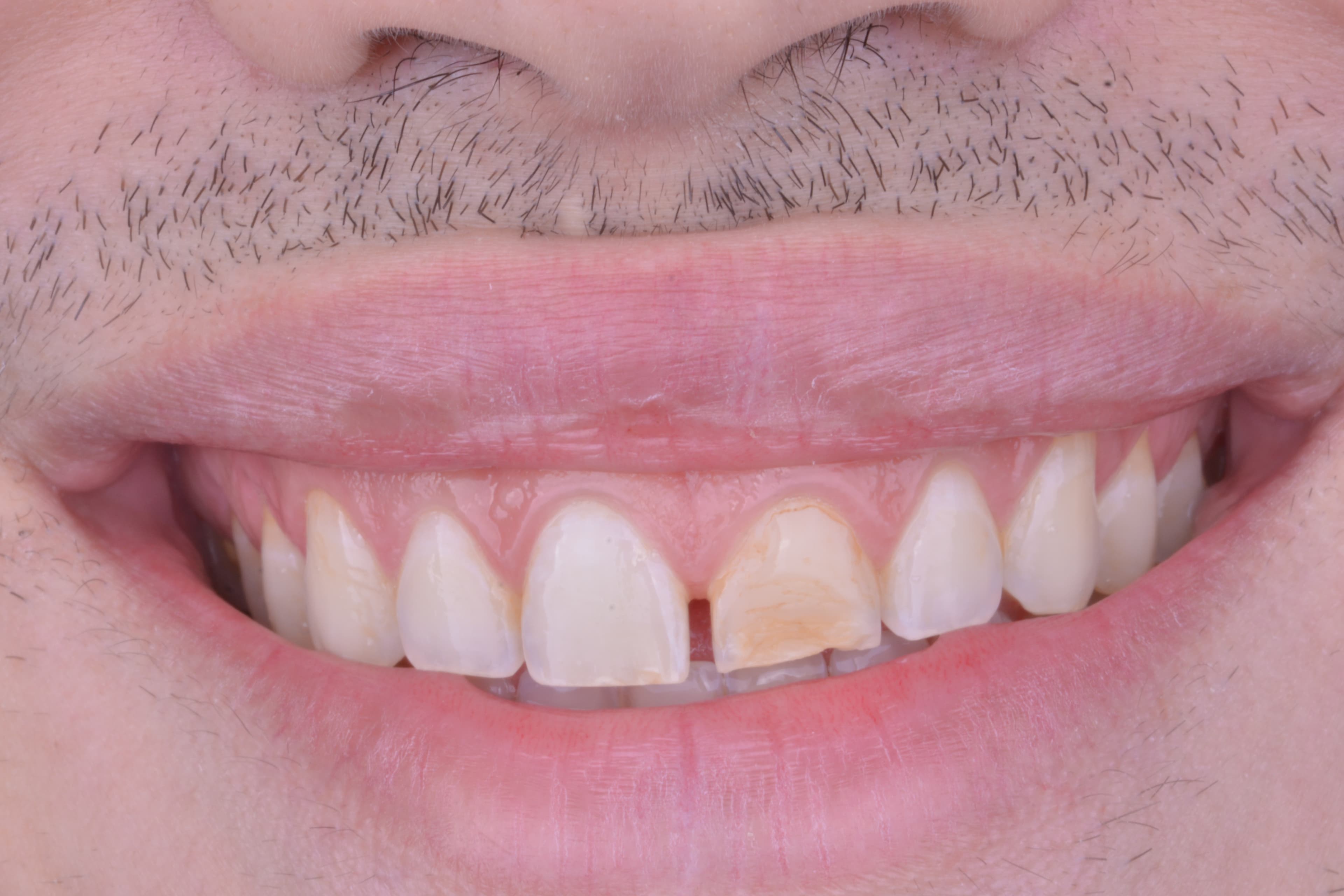 Before Carilla en resina