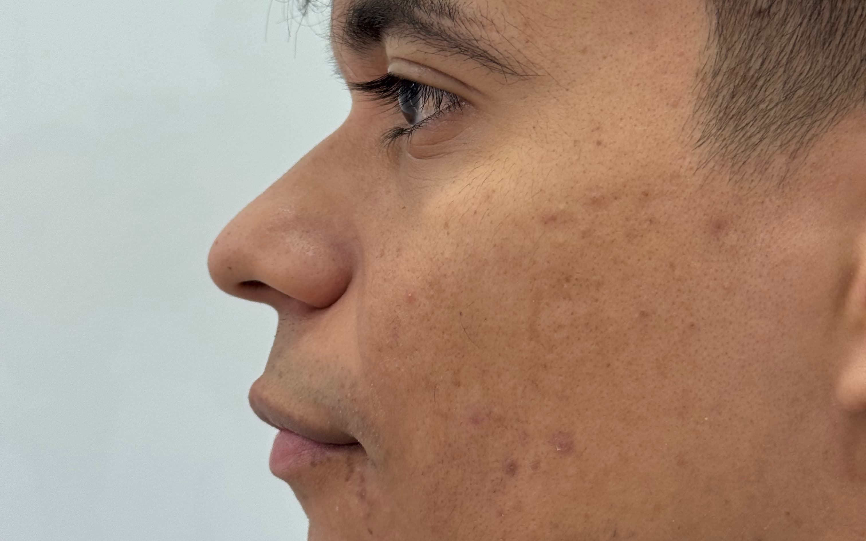 Before Ultrasonic rhinoplasty