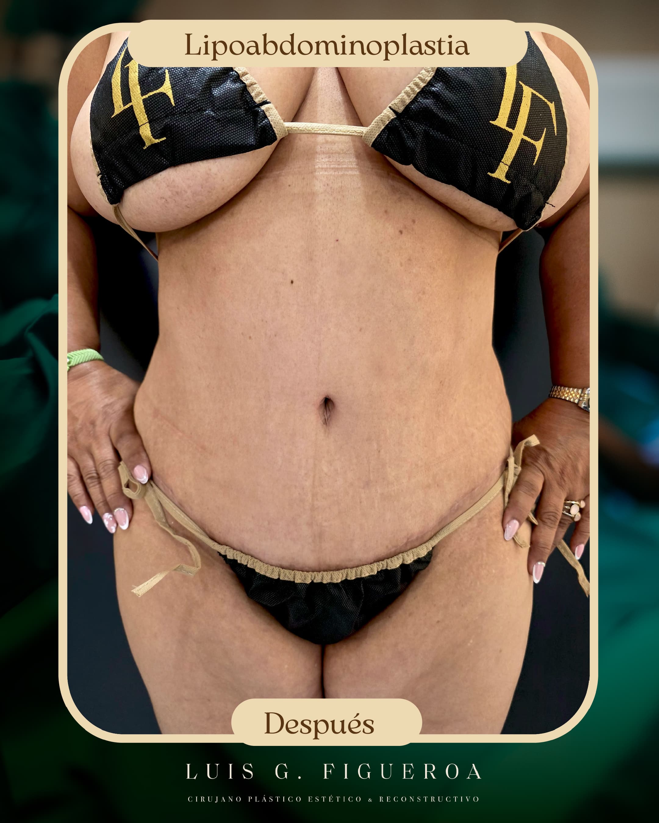 After Lipoabdominoplastia