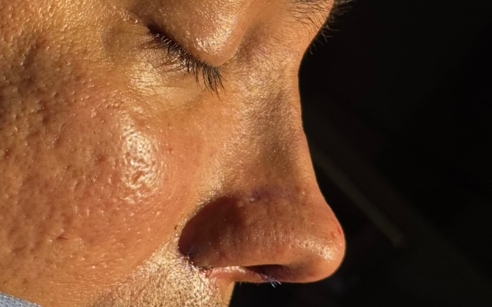 After Ultrasonic rhinoplasty