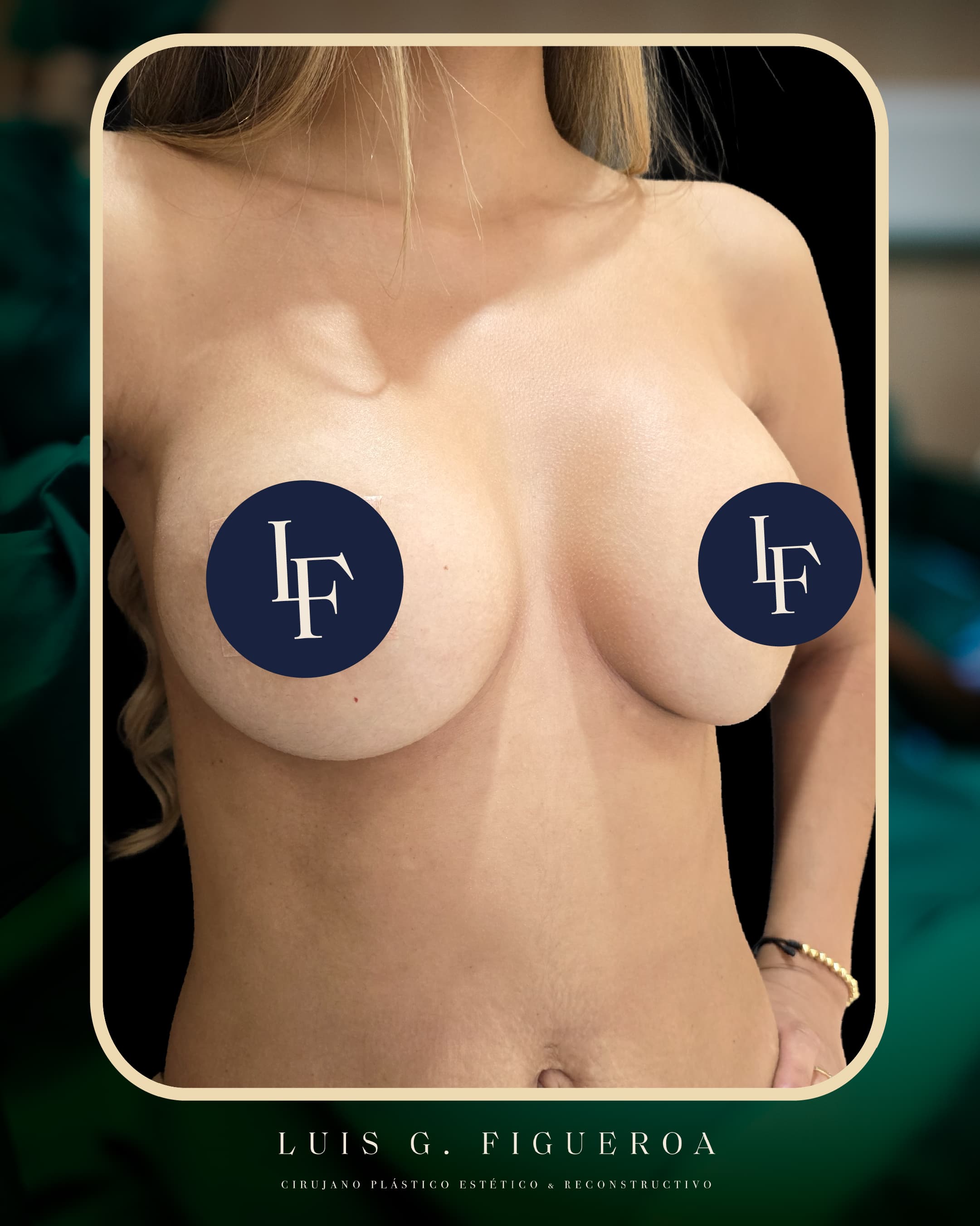 After Recambio de implantes