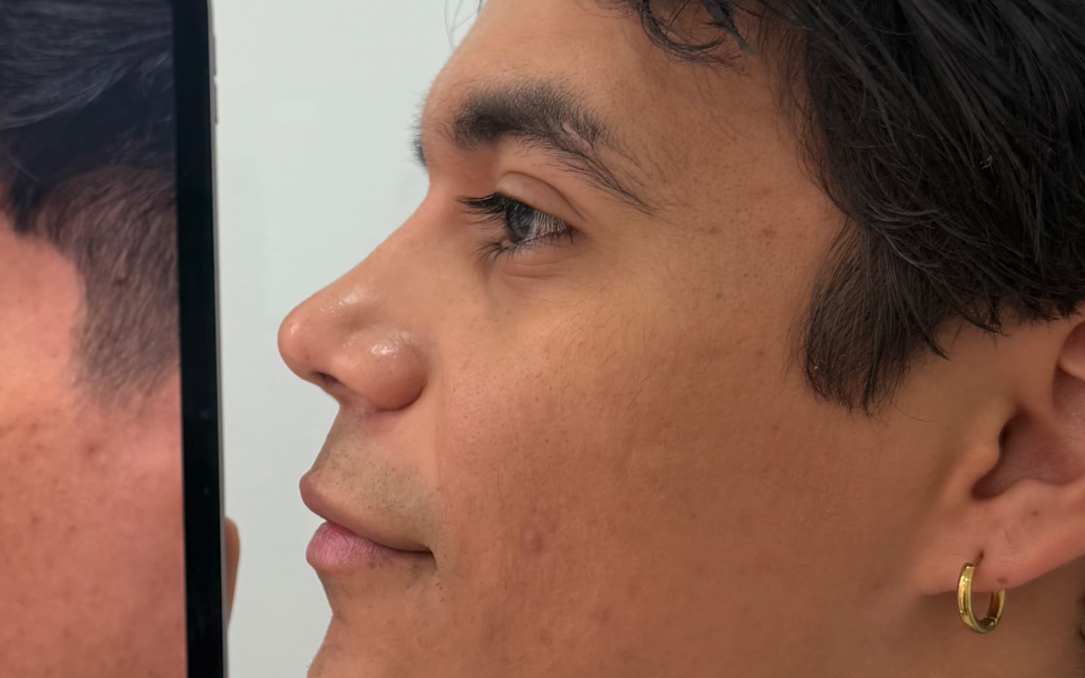 After Ultrasonic rhinoplasty