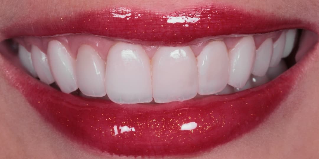 After Porcelain Veneers 