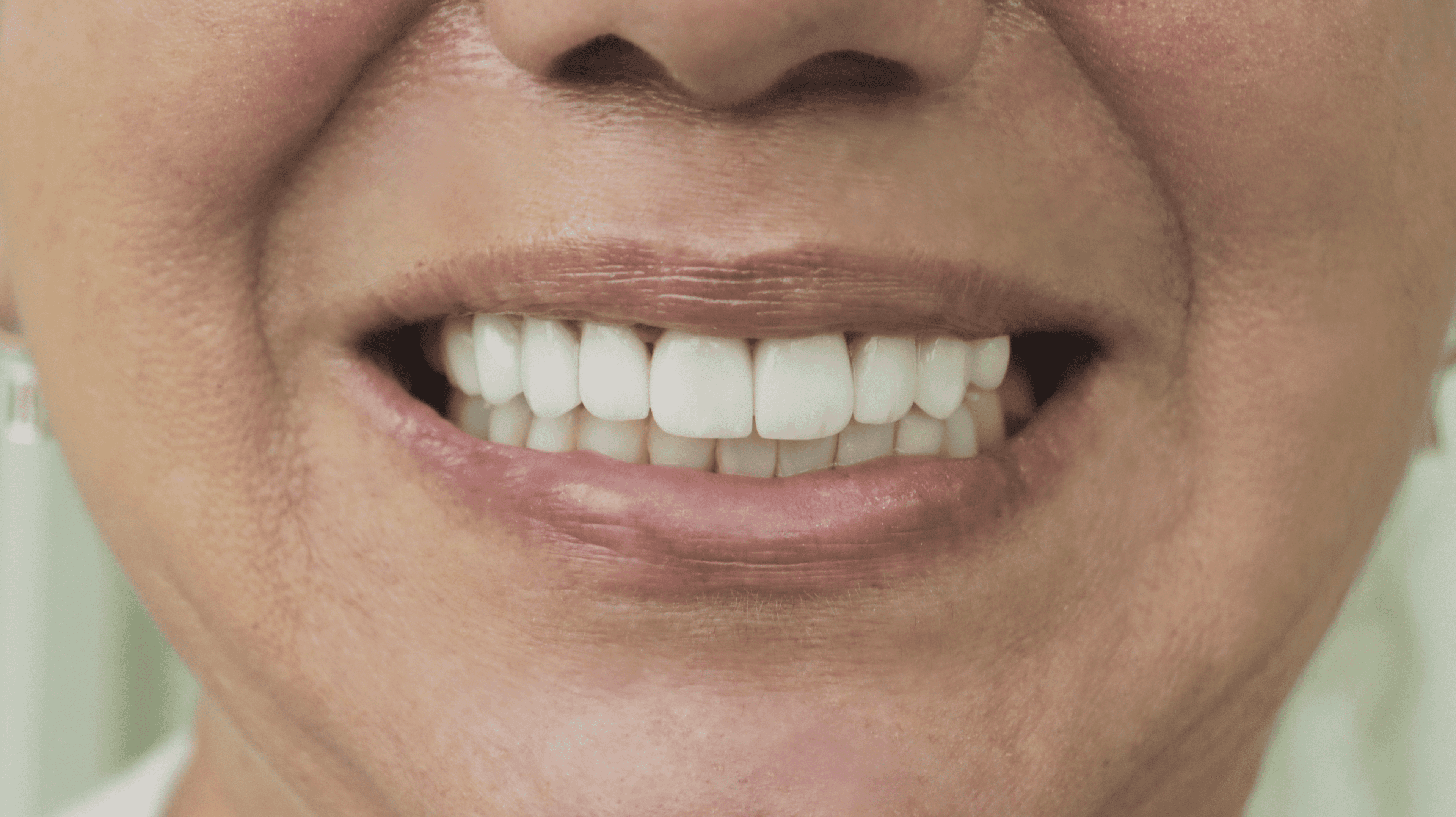 After Lentes Cerámicos Naturales