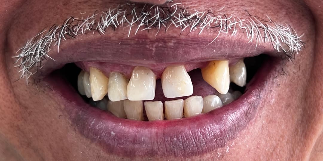 Before Rehabilitación + carillas cerámicas