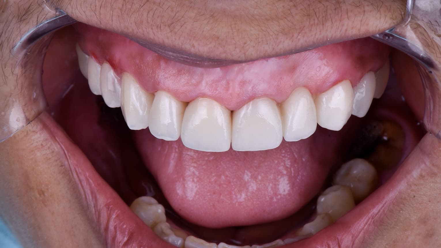 After Coronas en circonio, con estratificación ceramica