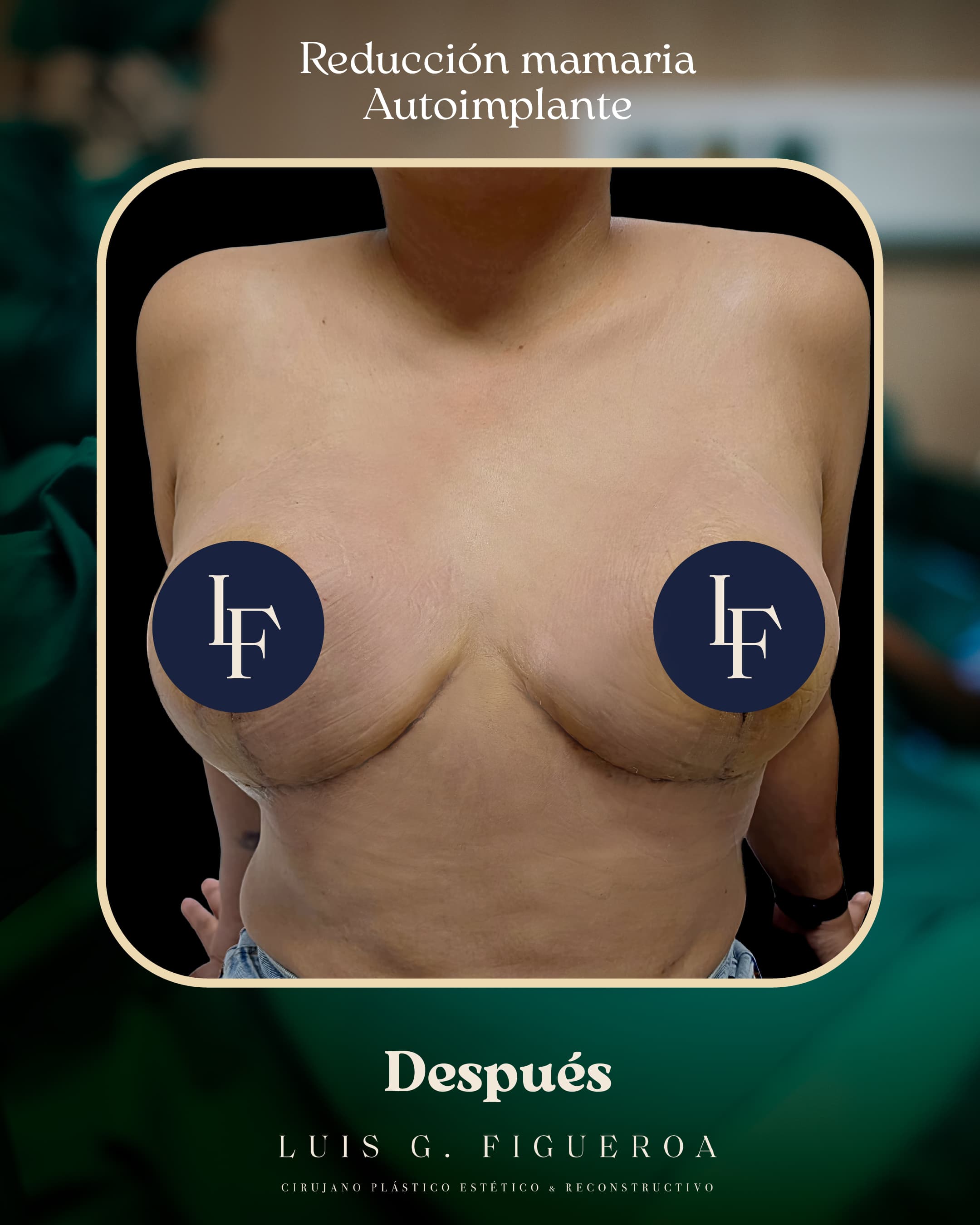 After Reducción mamaria autoimplante