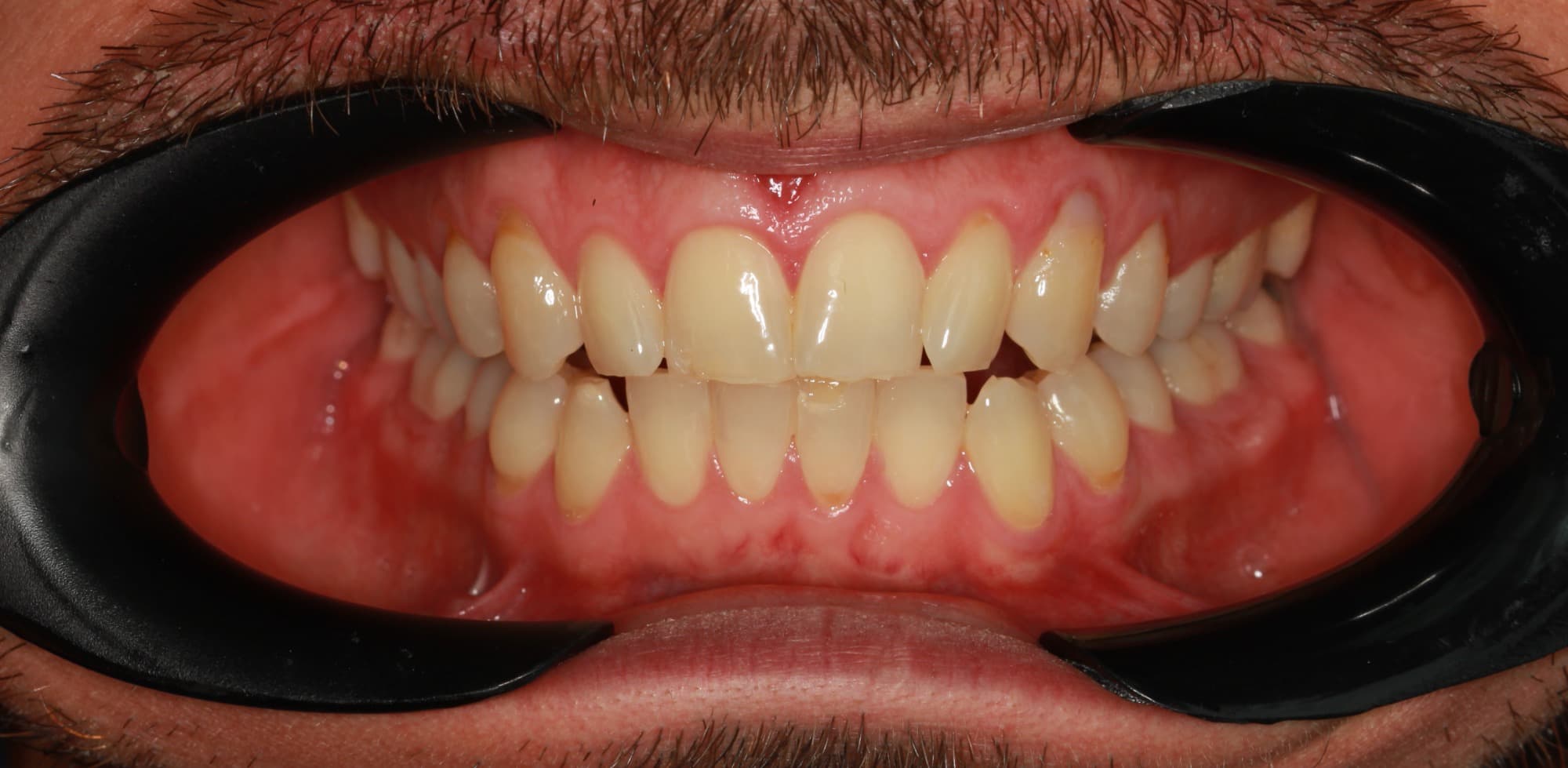 Before Lentes Cerámicos 