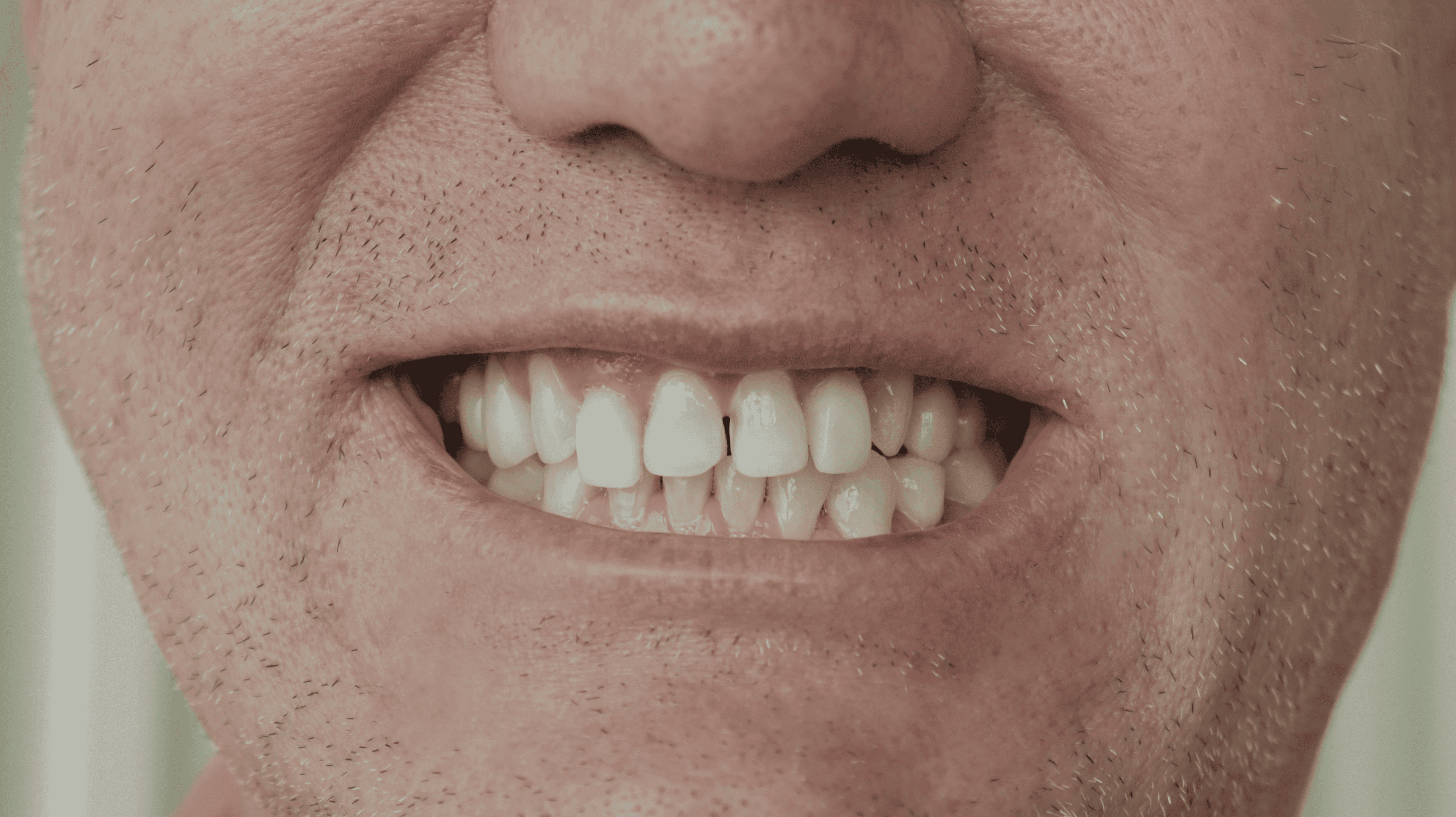 Before Lentes Ceramicos Naturales 