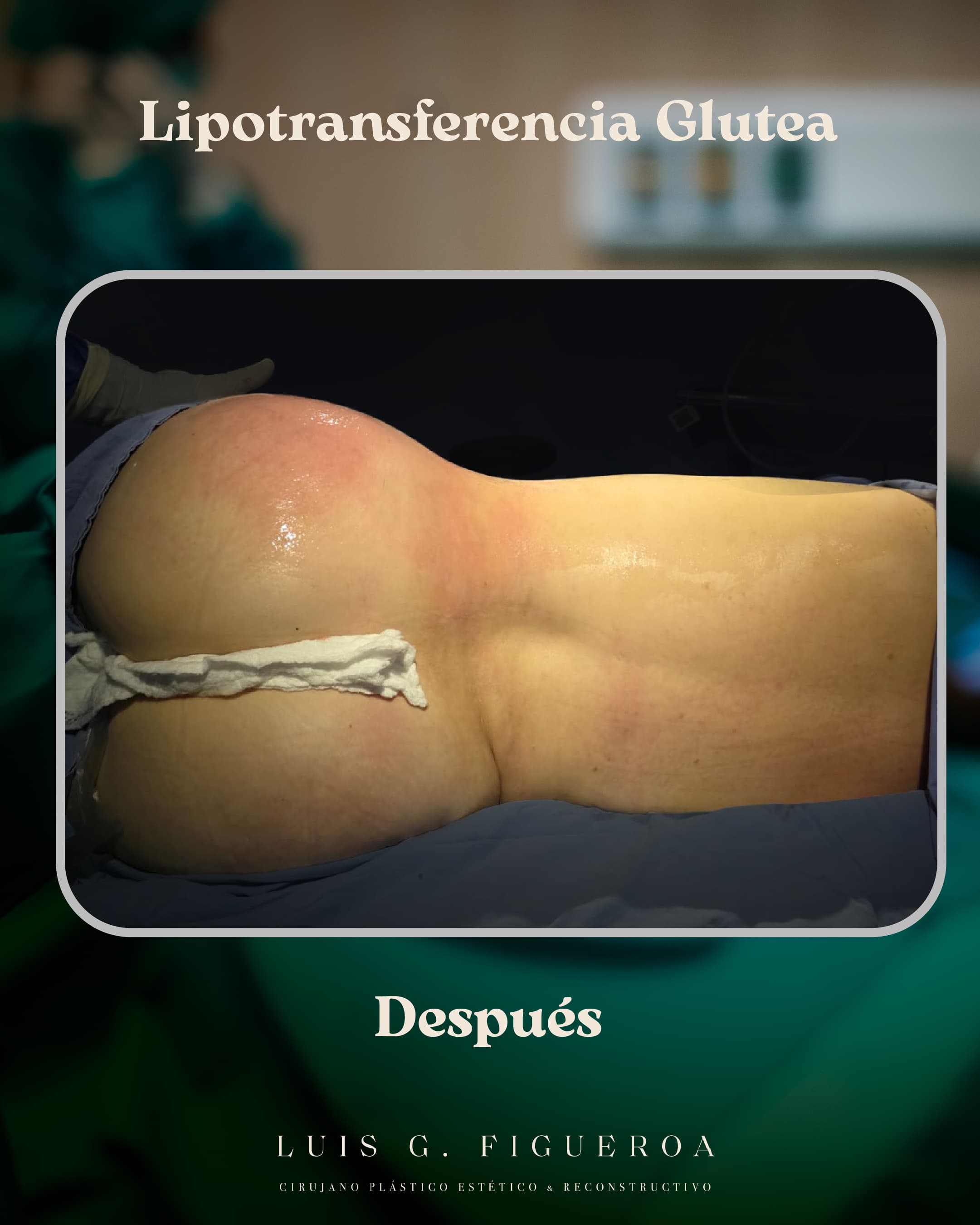 After Lipotransferencia